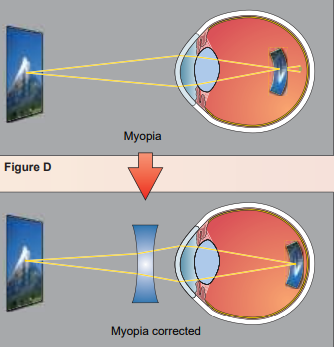 <ul><li><p>Nearsightedness </p></li><li><p>Eye is too long → Image converges in front of retina </p></li><li><p>Corrected with convex lens</p></li></ul>