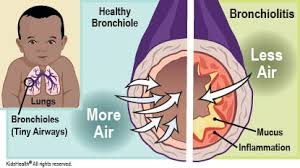 <p>bronchiolitis (lower airway infection)</p>