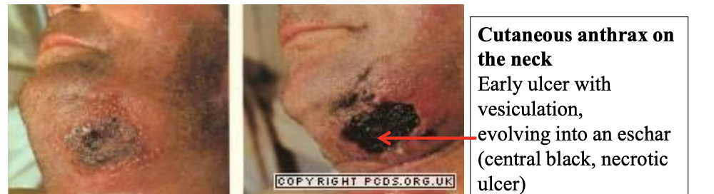 <p>Entry of spores (exposed areas of arms and hands or injured skin)</p><p>Pruritic papule- vesicle-necrotic ulcer- edema-eschar</p><p>Lymphangitis and lymphadenopathy and systemic signs and symptoms of fever, malaise and headache may occur.</p><p>May lead to sepsis</p>