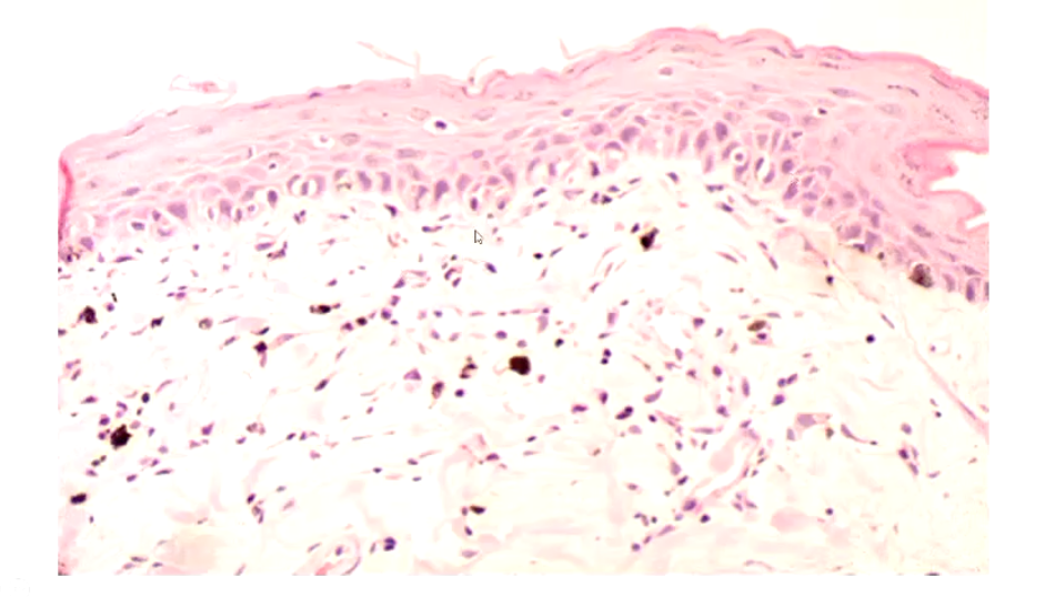 <p>Pigmentary incontinence - the melanocytes are leaking melanin </p>
