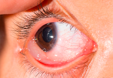 <p>Edema de la conjuntiva ocular.</p>