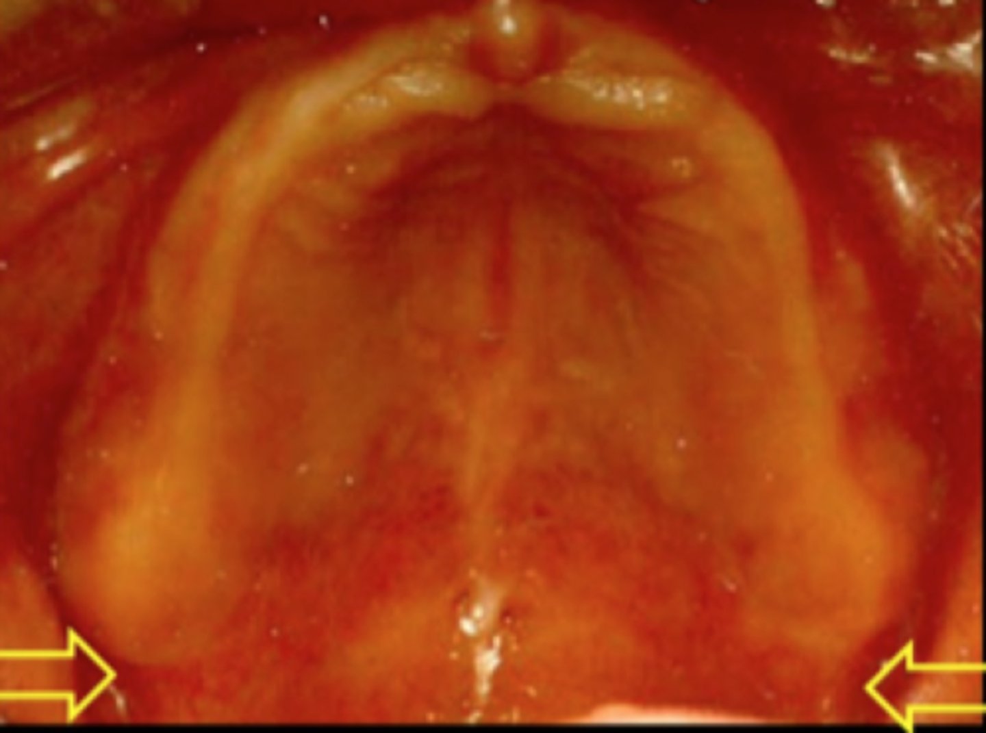 <p>narrow cleft that extends from the tuberosity to the pterygoid hamulus muscles. The pterygomandibular ligament attaches to the pterygoid hamulus which is a thin curved process at the terminal end of the medial pterygoid plate of the sphenoid bone.</p>