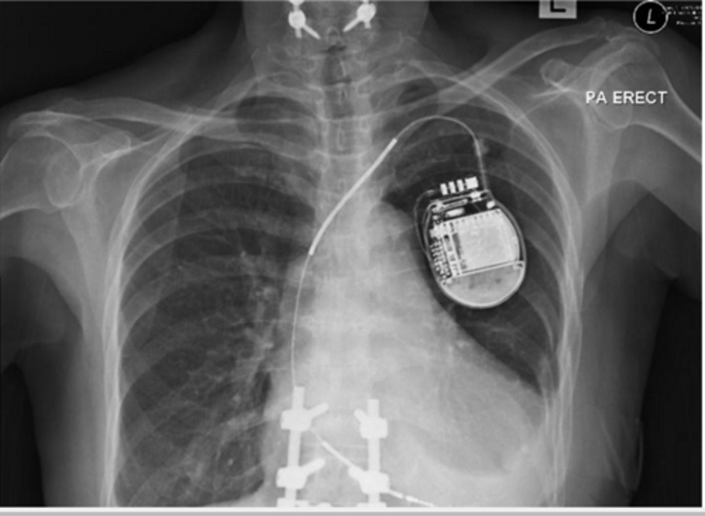 <p>An external or implantable device that provides an electric shock to the heart to restore a normal sinus rhythm.</p>