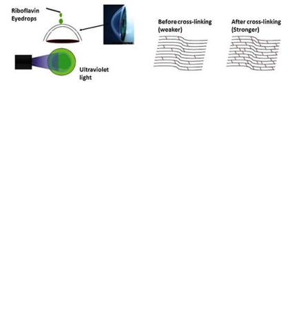 <p>riboflavin (vit B2) + UVA radiation</p><ul><li><p>photosensitizer - absorbs UV radiation causing a cleavage of oxygen, which splits off and causes cross-linking in the tissue</p></li><li><p>more crosslinks = STRONGER tissue</p></li></ul>