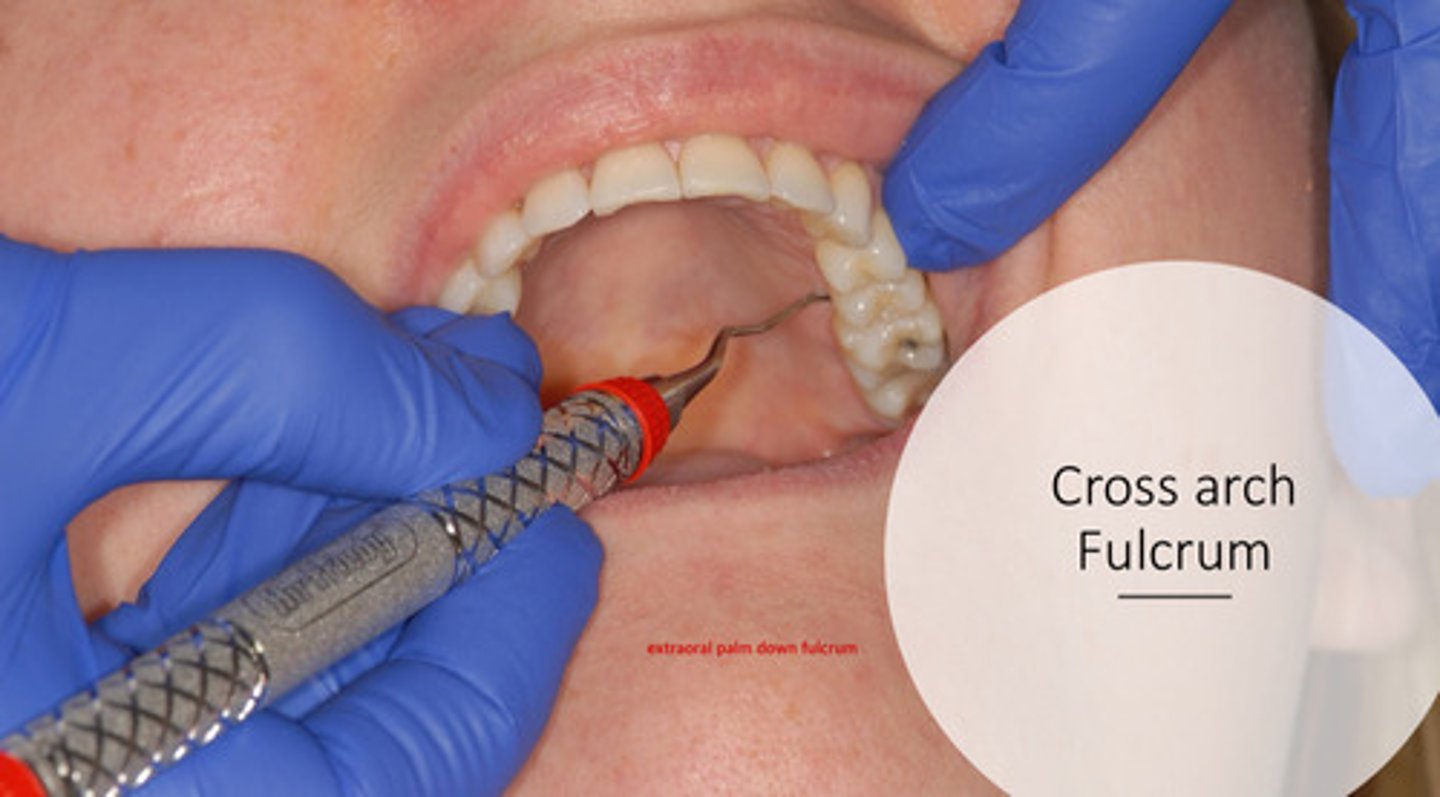 <p>typically an extraoral palm down fulcrum for maxillary area (ie for lingual left posterior side)</p>