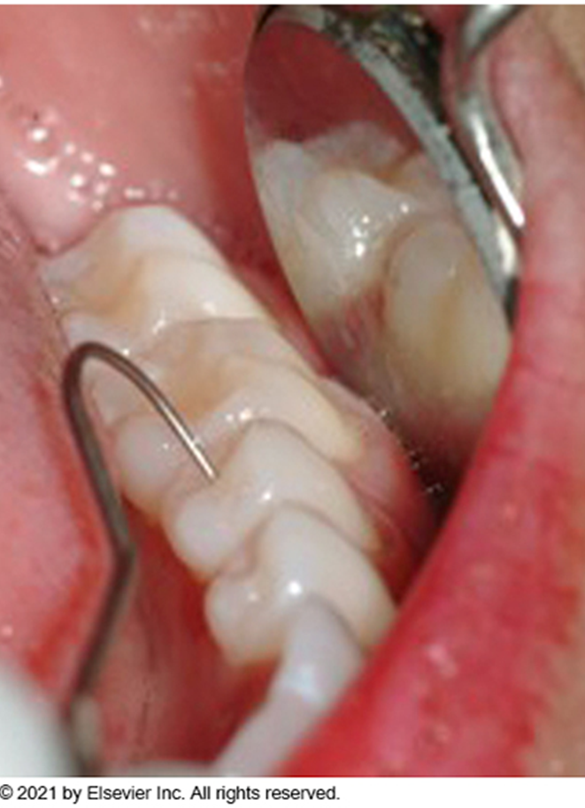 <p>The use of instruments to examine the teeth and surrounding tissues</p><p>Type of instruments commonly utilized to examine the teeth: Mouth mirror and explorer</p><p>Type of instrument used to examine the gingival tissues: Periodontal probe</p><p>Detection: Dentist uses an explorer to detect imperfections in tooth surfaces</p><p>Probing: Dentist or dental hygienist uses the periodontal probe to assess the gingiva for the presence of periodontal pockets</p>