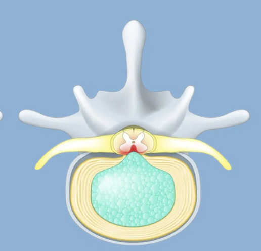 <p>The nucleus pulposus (<span><span>soft, jelly-like center of a spinal disc) </span></span>has broken through the surrounding annulus fibrosus and can compress spinal nerves, <span><span>irritating nearby nerves and causing pain, numbness, or weakness</span></span></p>