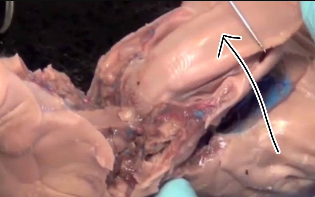 <p>There are bumps on the organ the arrow is pointing at. What are they?</p>