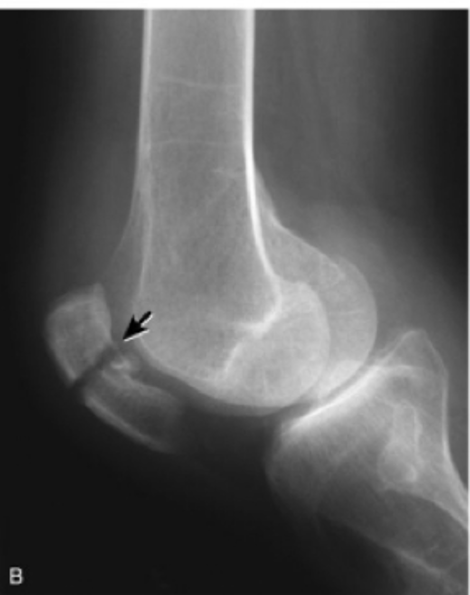 <p>MOI: direct fall, direct hit, forceful extension<br>Surgery is typical</p>