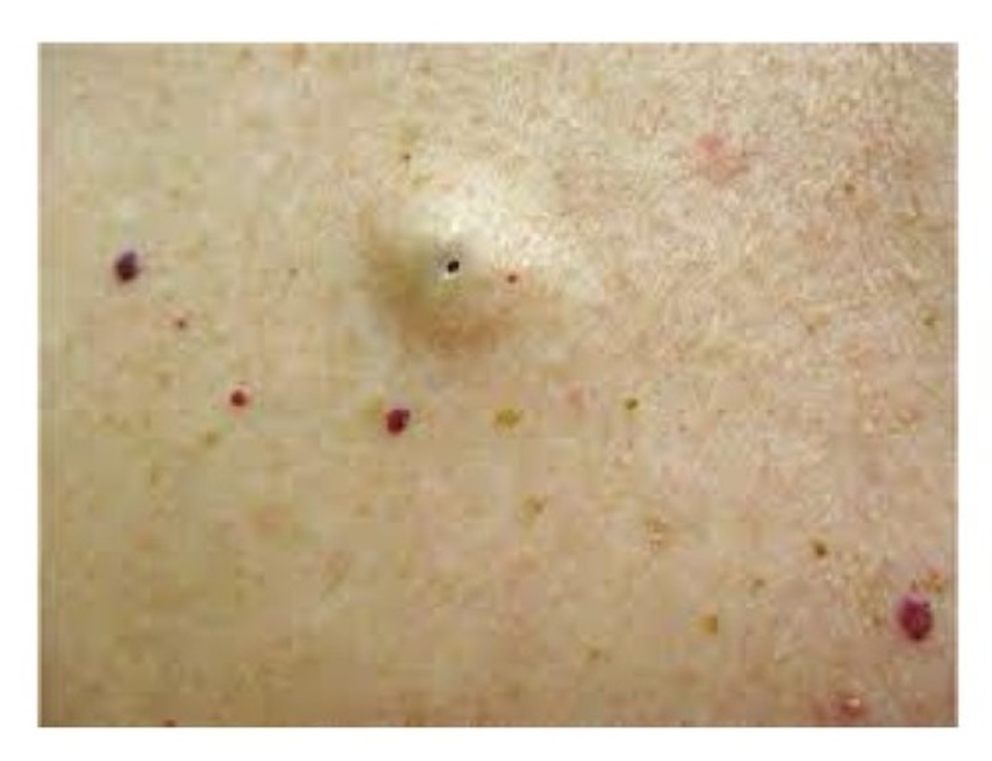 <p>A raised nodule on the skin of the face or neck. May be noted intraorally on occasion. Lined by keratinized epithelium that resembles the epithelium of the skin. Lumen is filled with keratin scales. Tx: surgical excision.</p>