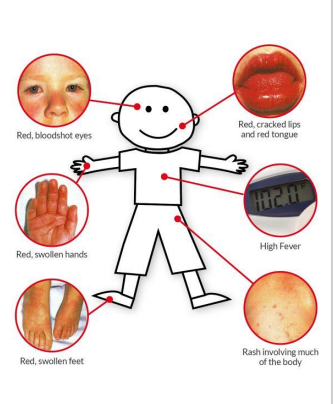 <p>Dx: ULS hjärta, CXR, ECG.</p><p>En <strong>4-årig pojke</strong> med:</p><ul><li><p class="ds-markdown-paragraph"><strong>Långvarig hög feber (6 dagar, 40,2°C)</strong>.</p></li><li><p class="ds-markdown-paragraph"><strong>Diffust polymorft utslag</strong> på bålen.</p></li><li><p class="ds-markdown-paragraph"><strong>Kraftigt röda ögon (konjunktivit)</strong> + <strong>såriga läppar</strong>.</p></li><li><p class="ds-markdown-paragraph"><strong>Förstorad halslymfkörtel</strong>.</p></li><li><p class="ds-markdown-paragraph"><strong>Svullna, röda handflator/fotsulor</strong>.</p></li></ul><div data-type="horizontalRule"><hr></div><p><strong>Mest sannolik diagnos: B. Kawasakis sjukdom</strong></p>