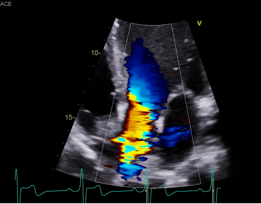 <p>Zoom on AV and demonstrate 2D+ color in A5C</p>