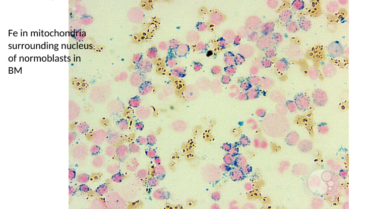 <p>Ring Sideroblasts</p>