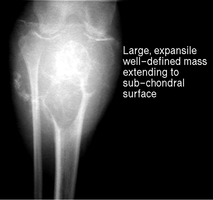 <p>benign tumor that commonly occurs in knee, often proximal to tibia</p>