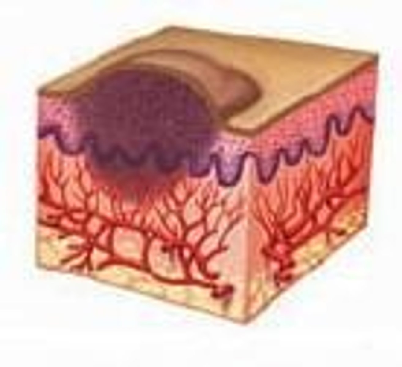 <p>An augmentation of scar tissue that forms after injury.</p>