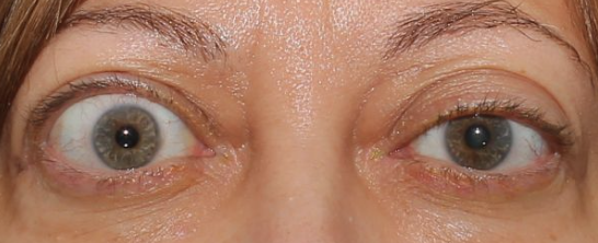 <p>Abnormalities of the External Eye</p><ul><li><p>Protruding eyeballs and retracted eyelids</p></li></ul><p></p>