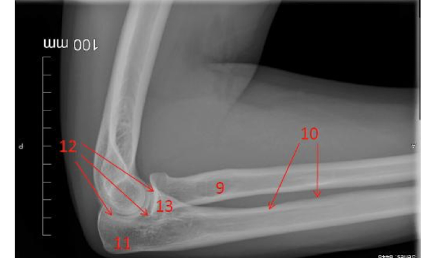 <p>Label the Upper Extremity in the photo provided.</p>