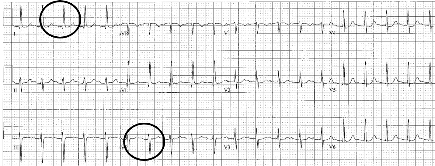 <p>I mostly pos. aVF mostly neg</p>