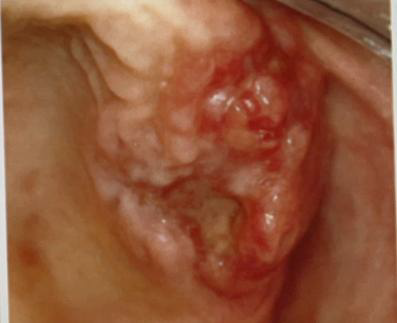 <ul><li><p>Identify the disease</p></li><li><p>One major form the disease</p></li><li><p>Etiology</p></li><li><p>Pathogenesis</p></li><li><p>Clinical feature</p></li><li><p>Oral manifestation</p></li><li><p>Forms of the disease</p></li><li><p>Histopathologic manifestation</p></li><li><p>Differential diagnosis</p></li><li><p>Definitive diagnosis</p></li><li><p>Treatment</p></li></ul><p></p>