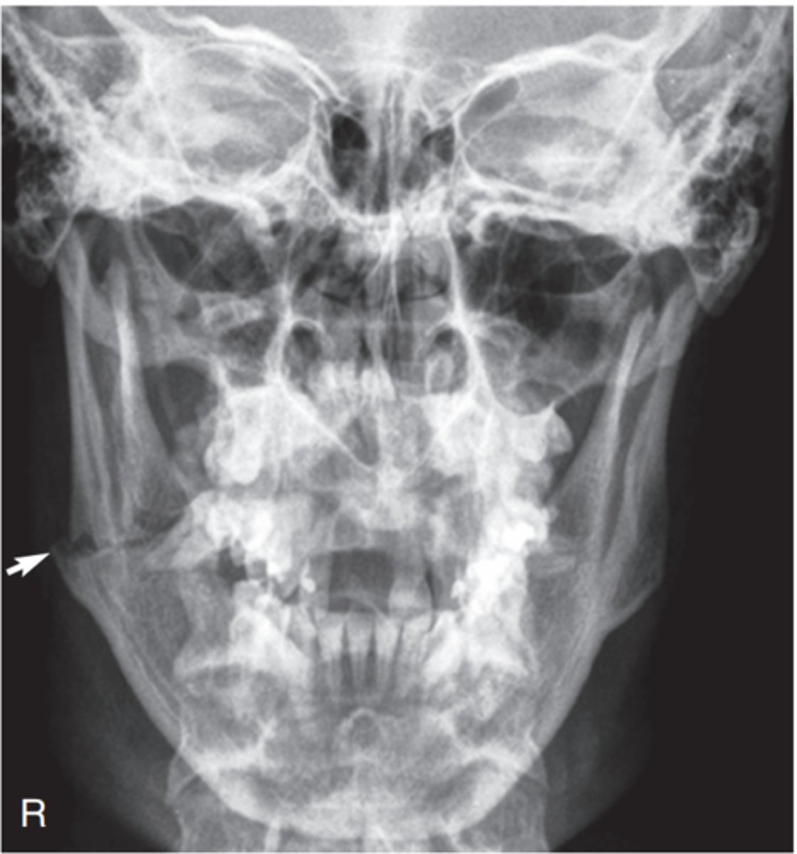 <p>-Position:</p><p>• No patient rotation exists, as indicated by mandibular rami visualized symmetrically, lateral to the cervical spine.</p><p>• Midbody and mentum are faintly visualized, superimposed on cervical spine.</p>