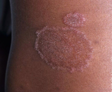 <p><strong>Tinea Corporis</strong> </p><p>-Found anywhere on the body except ____, groin, face, ______, or nails </p><p>-Most common organism is __.______. Could also be T. mentagrophytes or M. canis </p><p>-Infected by _____ skin contact w/infected person or animal, contact with fomites, secondary spread</p><p>-Begins as _______, circular/oval, erythematous, _______ patch/plaque followed by central _________ with _______ border “ringworm” </p><p>-___ prep of skin scraping shows segmented _______</p><p>-Treatment </p><ul><li><p>Topical _________ agents of azoles, allylamines </p></li><li><p>Oral antifungals of terbinafine, ___________, griseofulvin if extensive skin involvement or failure of topical treatment </p></li><li><p>Do not use ________</p></li></ul><p></p>