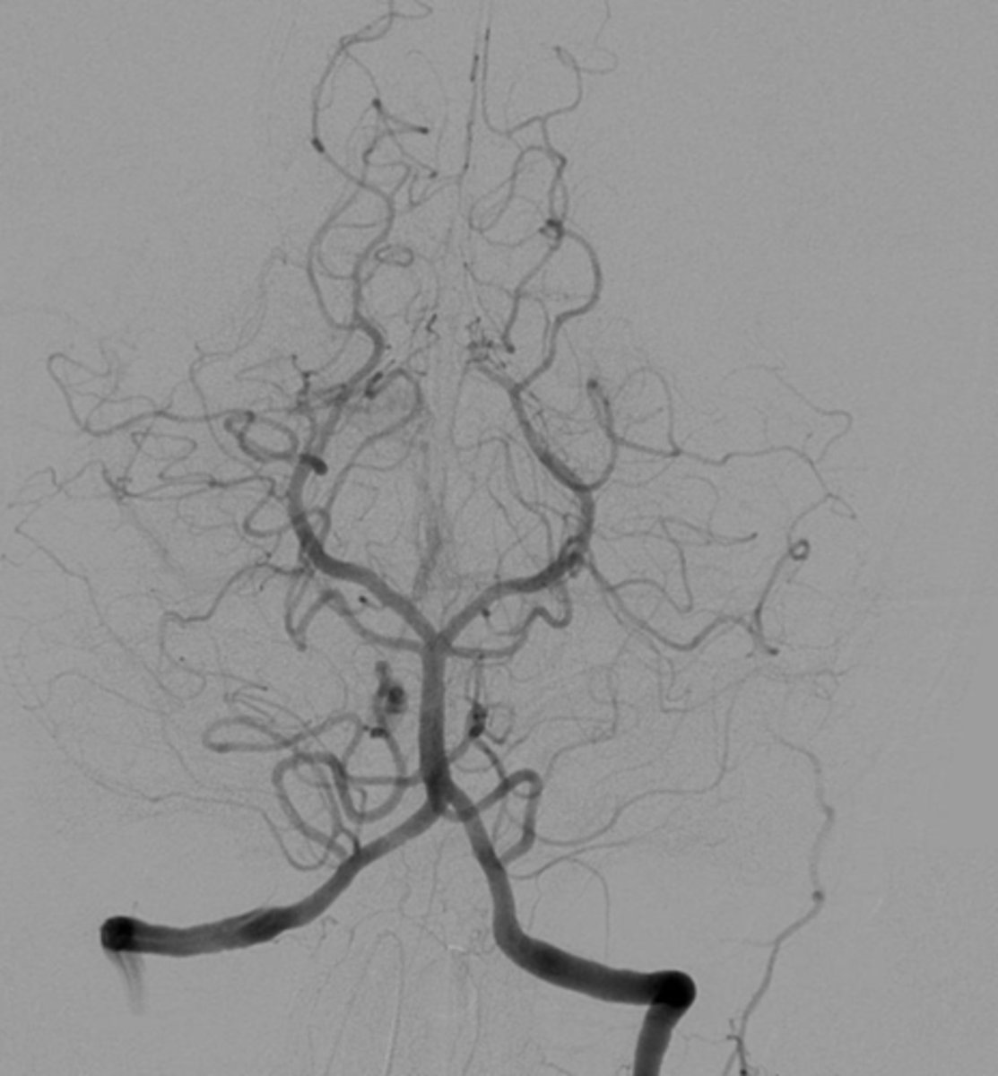 <p>- Is an X-Ray examination of the arteries, or blood vessels. To make the arteries visible on x-ray, a type of dye called "contrast" is injected</p><p>- Is a medical imaging technique used to visualize the inside, or lumen, of blood vessels and organs of the body, with particular interest in the arteries, veins, and the heart chambers</p>