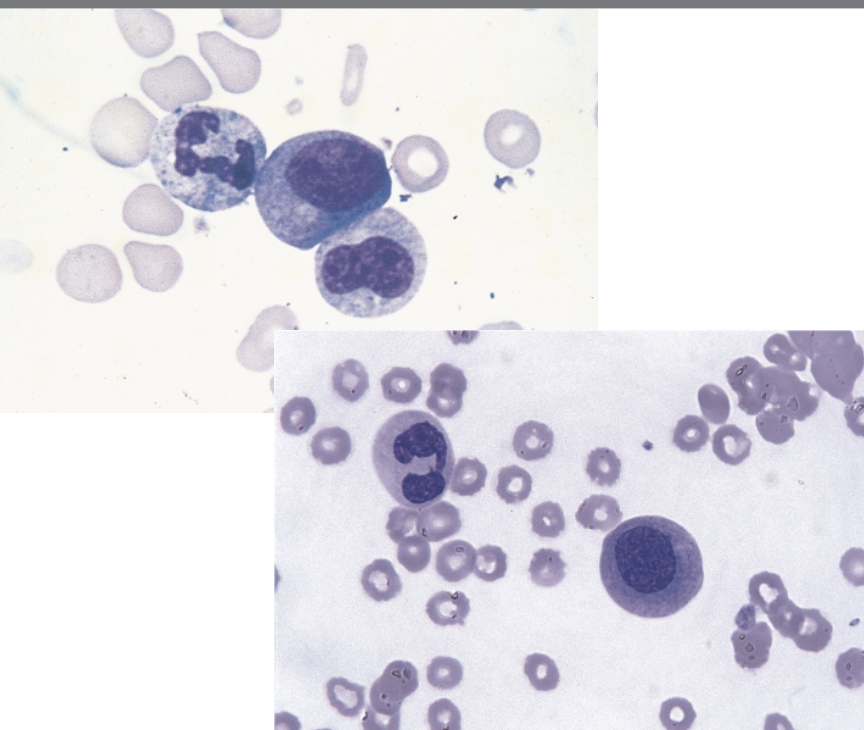 <p>these morphological abnormalities of the BM are characteristic of ____.</p>