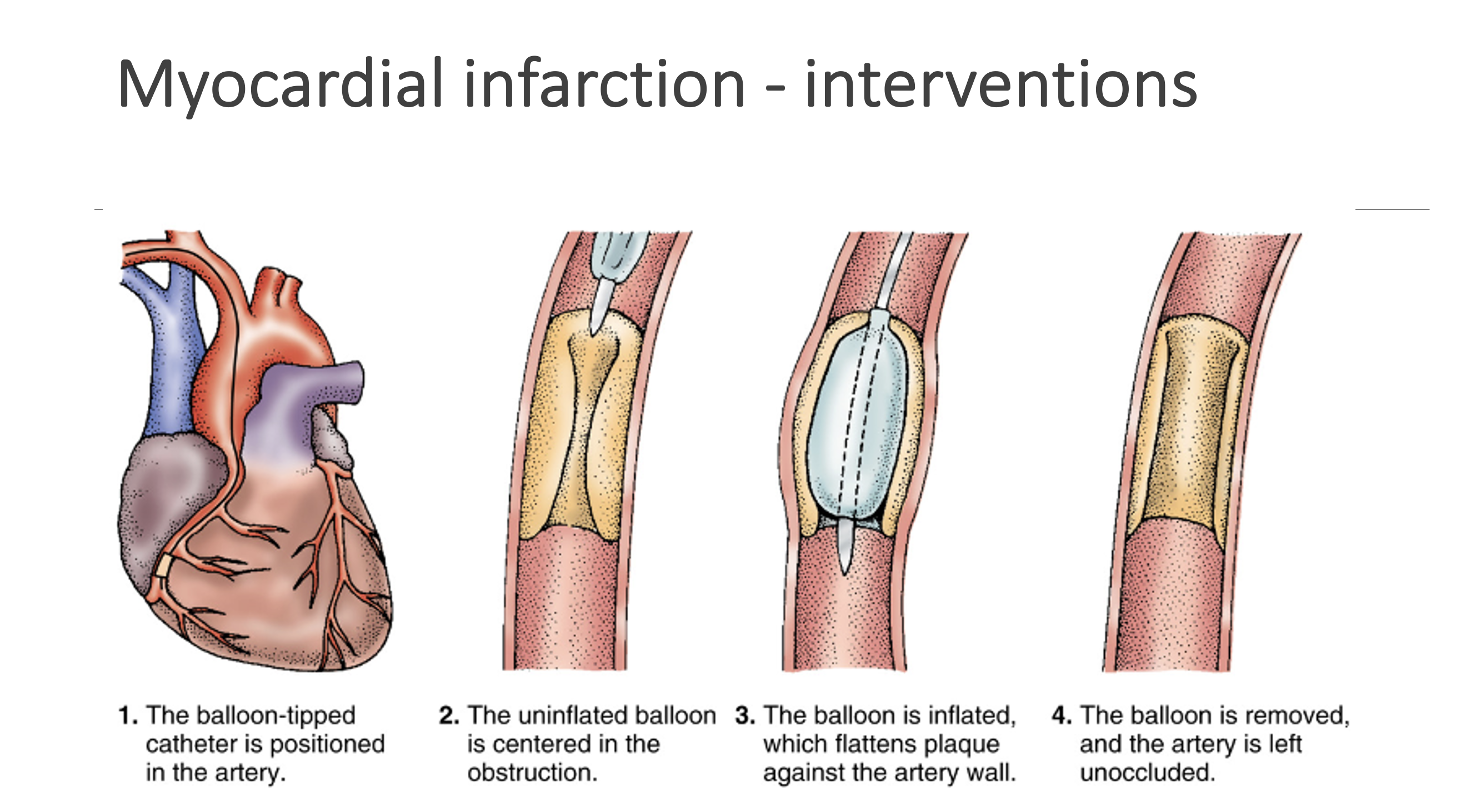 <p>Myocardial infarction - Interventions:&nbsp;Reperfusion therapy</p><p></p>