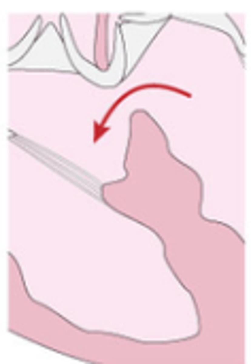 <p>found at structures where blood is leaving the heart around the pulmonic and aortic valve locations.</p>