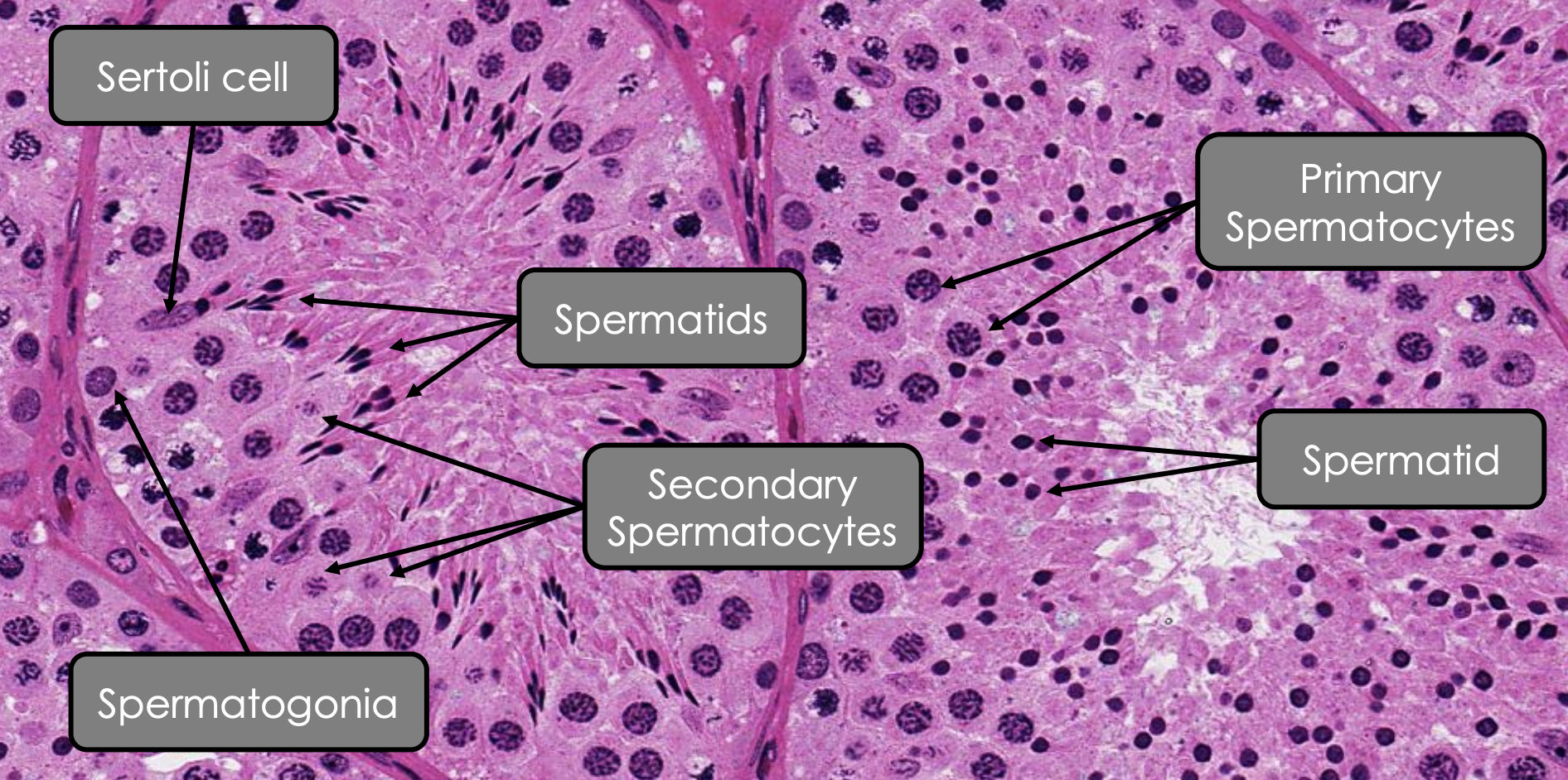 <p><strong><u>Shape:</u>&nbsp;</strong><span style="color: rgb(255, 131, 0);"><strong>Pyramidal cell&nbsp;</strong></span></p><p><strong><u>Location:</u>&nbsp;</strong><span style="color: rgb(255, 131, 0);"><strong>Extend</strong></span> the<strong> </strong><span style="color: rgb(255, 131, 0);"><strong>entire height</strong> </span>of<strong> </strong><span style="color: rgb(255, 131, 0);"><strong>spermatogenic epithelium</strong></span></p><p><strong><u>Nucleus:</u>&nbsp;</strong><span style="color: rgb(255, 131, 0);"><strong>Ovoid</strong></span>&nbsp;and<strong>&nbsp;</strong><span style="color: rgb(255, 131, 0);"><strong>euchromatic</strong></span><strong>&nbsp;</strong></p><p><strong><u>Abundant organelles:</u></strong></p><ul><li><p><span style="color: rgb(255, 131, 0);"><strong>Cytoplasmic projections</strong></span>&nbsp;to all spermatogenic epithelium</p></li><li><p><span style="color: rgb(255, 131, 0);"><strong>GA</strong></span></p></li><li><p><span style="color: rgb(255, 131, 0);"><strong>Mitochondria </strong></span></p></li><li><p><span style="color: rgb(255, 131, 0);"><strong>sER</strong></span><strong> </strong>(<em>surrounds periacrosomal region of spermatid</em>) </p></li><li><p><span style="color: rgb(255, 131, 0);"><strong>Fat vacuoles</strong></span>&nbsp;(<em>at cellular base</em>)&nbsp;</p></li></ul><p><strong><u>How do they communicate with adjacent cells:</u> </strong><span style="color: rgb(255, 131, 0);"><strong>Tight junction</strong></span><strong> </strong>and <span style="color: rgb(255, 131, 0);"><strong>desmosomes</strong></span></p><p><strong><u>Function:</u>&nbsp;</strong></p><ul><li><p><span style="color: rgb(255, 131, 0);"><strong>Structural</strong></span> and<strong> </strong><span style="color: rgb(255, 131, 0);"><strong>nutiritonal support&nbsp;</strong></span></p></li><li><p><span style="color: rgb(255, 131, 0);"><strong>Intra-tubular fluid secretion&nbsp;</strong></span></p></li><li><p><span style="color: rgb(255, 131, 0);"><strong>Formation</strong></span> of<span style="color: rgb(255, 131, 0);"><strong> blood testis barrier</strong></span><strong>&nbsp;</strong></p></li></ul><p></p>