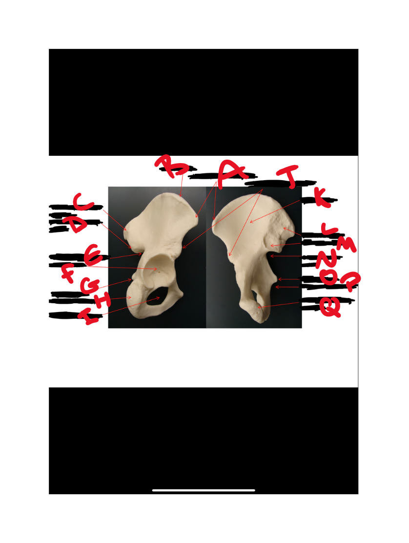 What bone is this?