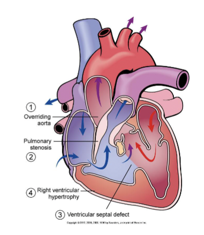 <ul><li><p><strong>dextroposition of the aorta</strong></p></li><li><p><strong>stenosis</strong> of pulmonary artery</p></li><li><p><strong>ventricular septal defect</strong> involving the uppermost membranous part of the septum</p></li><li><p><strong>hypertrophy of the right ventricle</strong>, which is adaptive in nature and develops as a result of an increased workload of the right ventricle</p></li></ul><p></p>