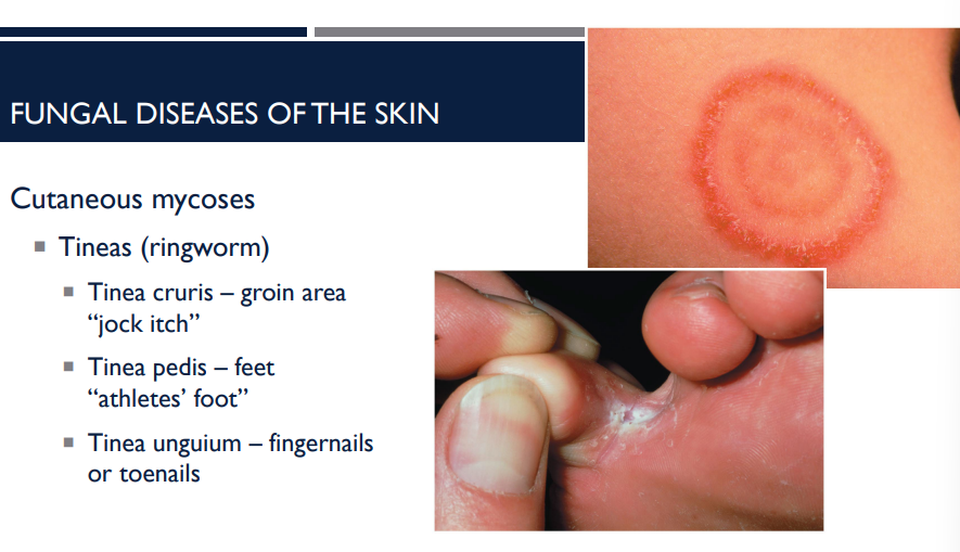 <p>Cutaneous mycoses can cause what fungal disease?</p>