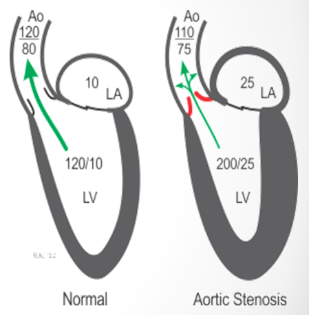 <p>concentric left ventricular hypertrophy</p><p>(LV must generate higher pressure to move blood through. It does this by thickening muscular walls EQUALLY aka concentric)&nbsp;</p>