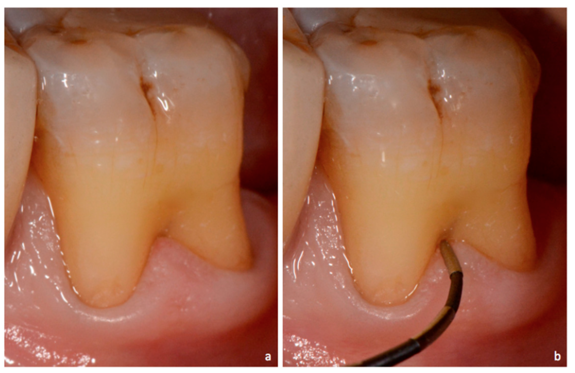 <p>Furcation involvement</p>