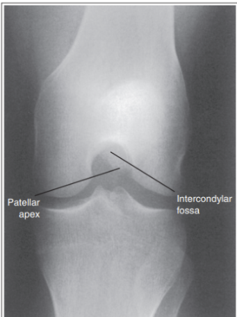 <p>What are the issues with this AP knee?</p>