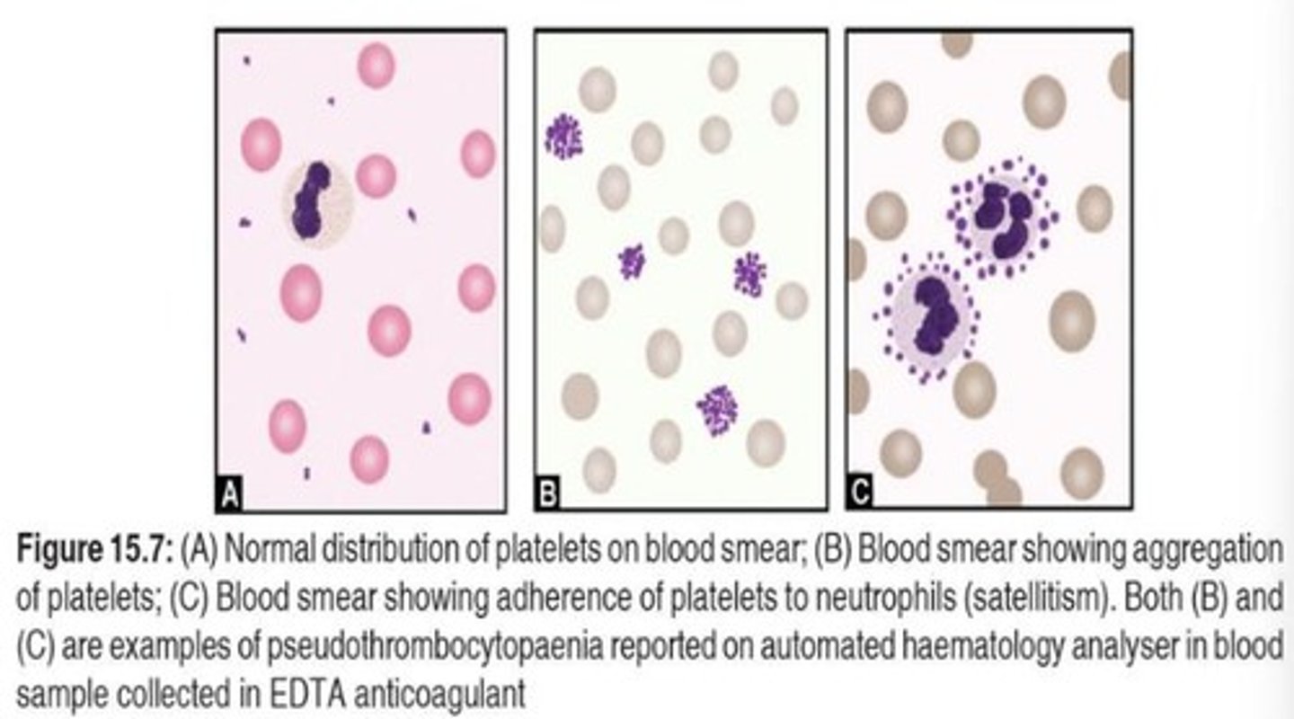 <p>False low platelet count due to aggregation.</p>