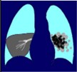 <ul><li><p>Bronchopneumonia</p><ul><li><p>spotted structure- patchy, inhomogenous</p></li><li><p>multifocal</p></li></ul></li><li><p>Lobar pneumonia</p><ul><li><p>respects borders of lobes</p></li><li><p>airbronchogram</p></li></ul></li></ul><p></p>