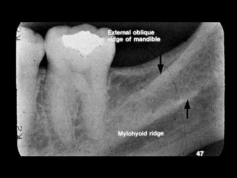<p>External Oblique Ridge </p><ul><li><p>linear prominence located on the external surface of the body of the mandible </p></li><li><p>Radiography: radiopaque band extended downwards and forward from the anterior border of the ramus </p></li></ul><p><strong><em>** when both internal and external oblique ridge is present, external is superior to internal</em></strong></p>