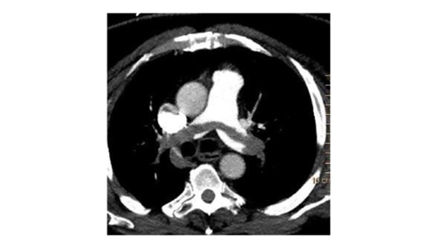 <p>CT chest with contrast</p>