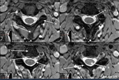 <p>Letter E in Image 19 is pointing to:</p><p>A. Ventral nerve root</p><p>B. Dorsal nerve root</p><p>C. Spinal cord</p><p>D. Transverse process</p><p>E. Cerebrospinal fluid (CSF)</p>