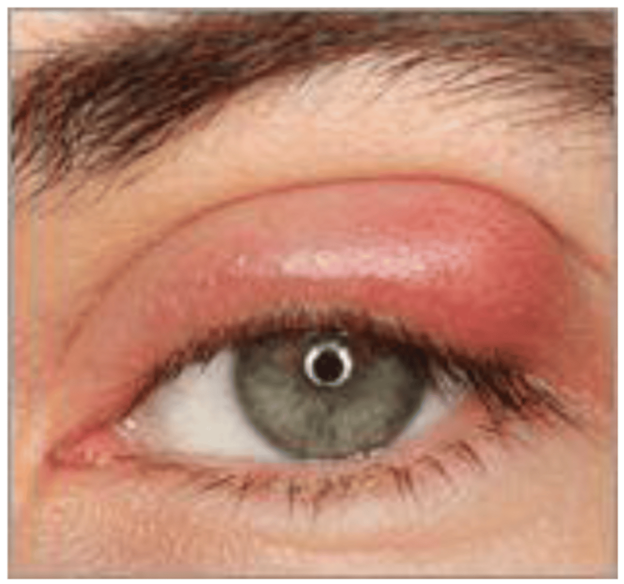 <p>A 30-year-old non-contact wearer presents with a red, irritated eye (pictured). What questions would you ask your patient to help</p><p>you with your diagnosis?</p>