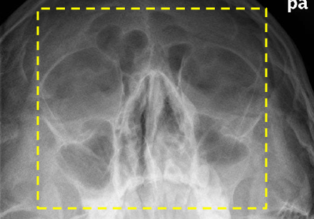 <p>Structures: nasal, frontonasal suture, maxillae, ant nasal spine</p>