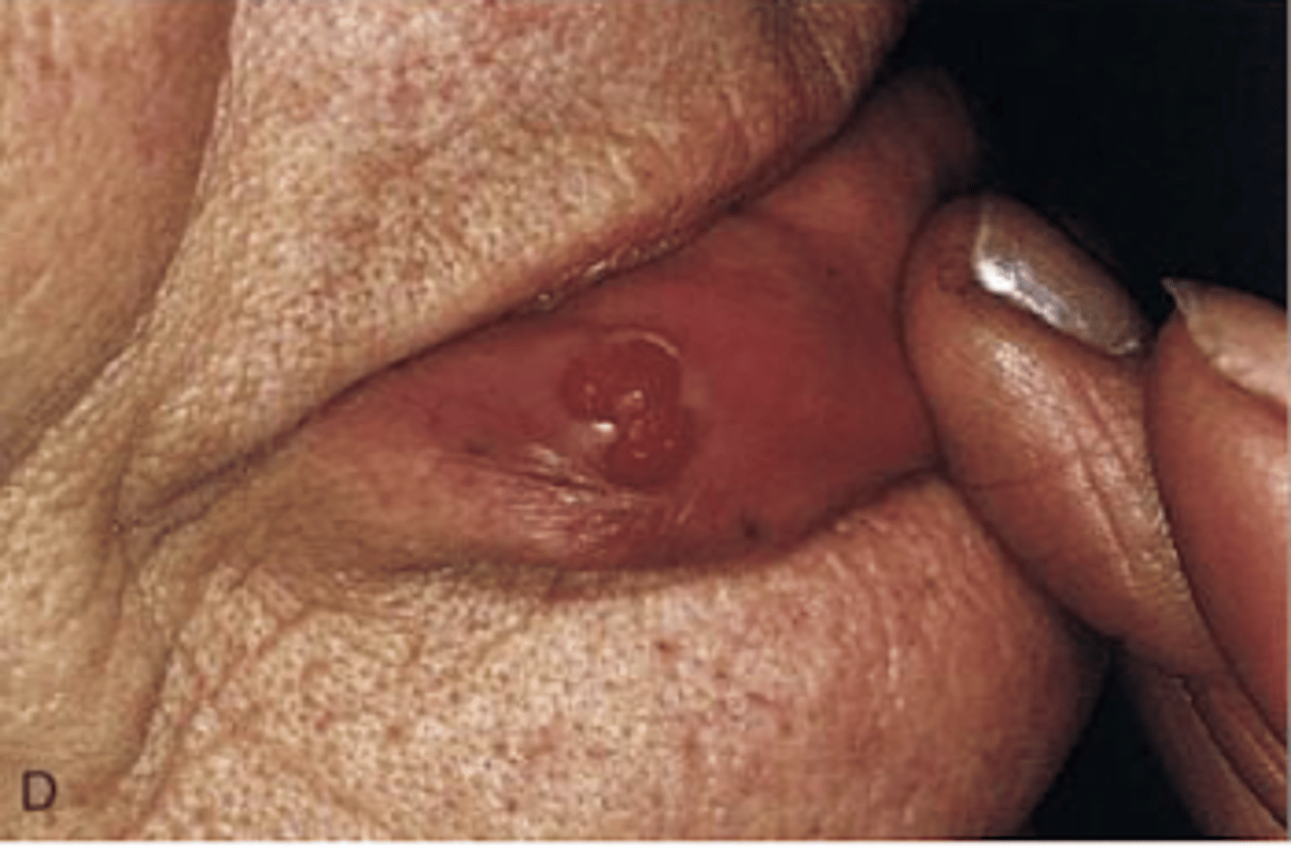 <p>rapidly growing reed lesion on skin, gingival, or oral mucosa</p><p>occur following trauma</p>