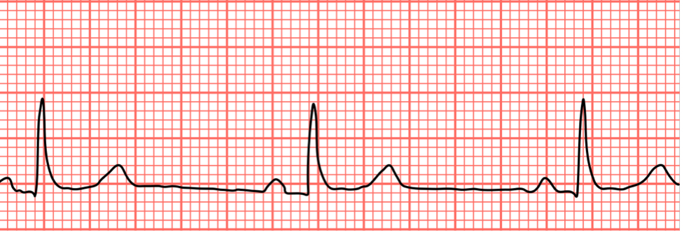 <p>HR less than 60 bpm</p>