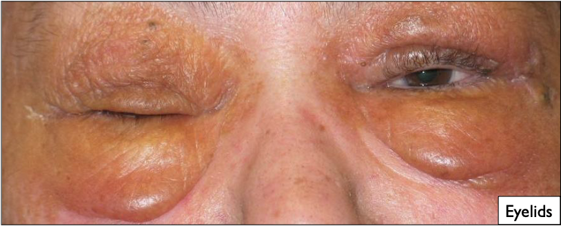 <p>Amyloidosis</p>