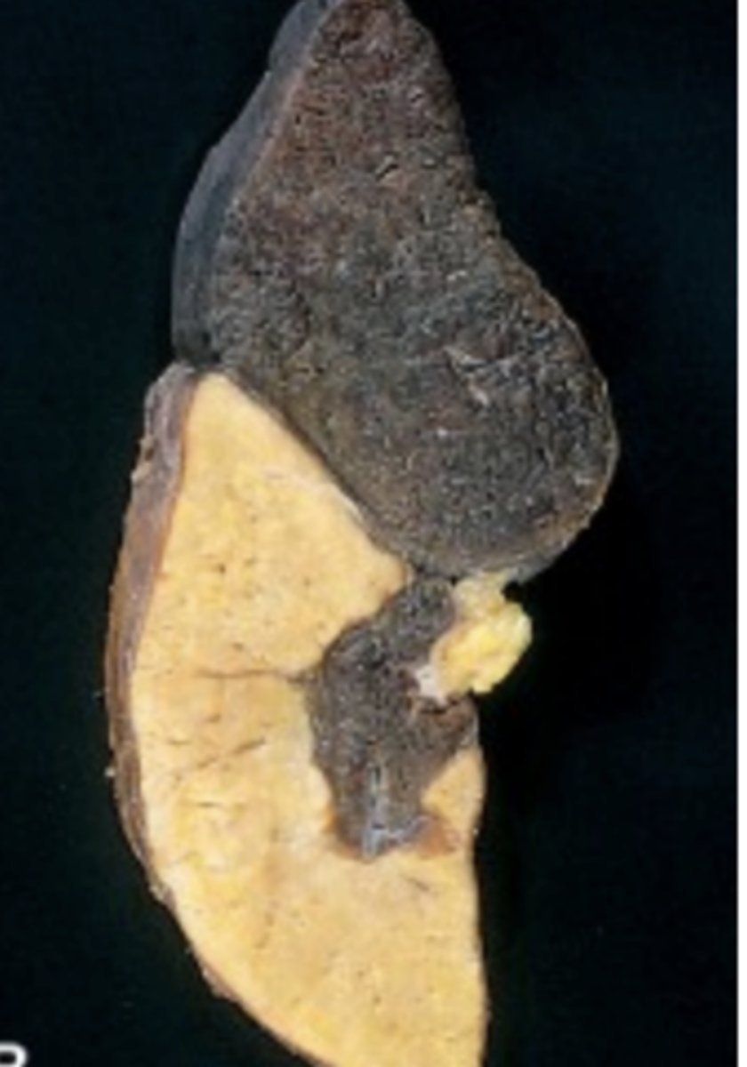<p>- Occur with arterial occlusion in solid organs (i.e. kidney and heart)</p><p>- The pale appearance of the organ due to the infarct occurs within 24 to 48 hours as any blood cells which seeped out into the tissue are lysed and the hemoglobin is broken down.</p>