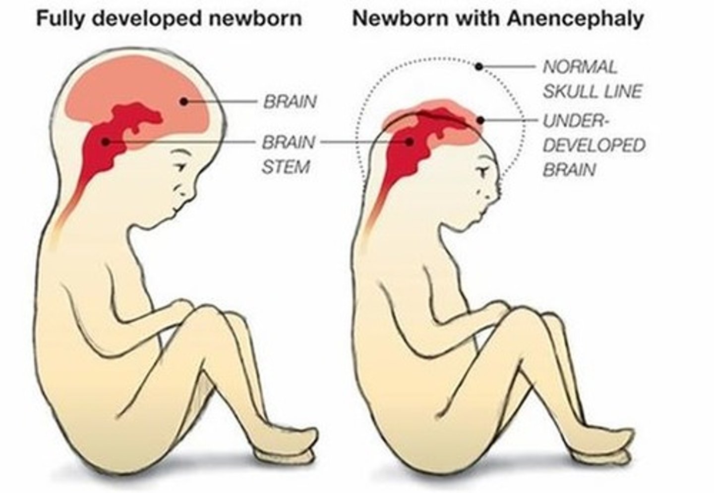 <p>Failure of the brain to form; can be caused by low levels of folic acid during preganancy</p>