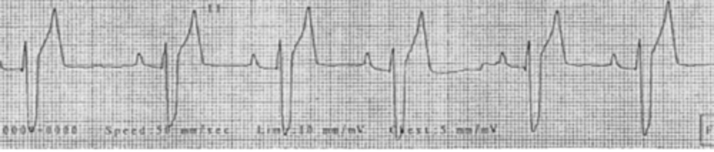 <p>Describe the heart rhythm shown by lead II</p>