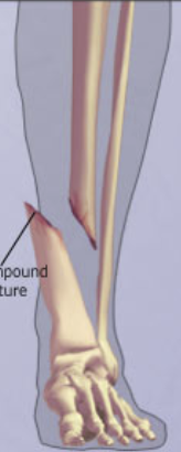 <p><span style="font-family: &quot;Trebuchet MS&quot;, sans-serif">Bone breaks through skin.</span></p>